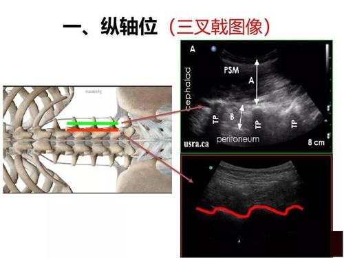 超声引导下神经阻滞技术是在超声引导下,探查神经走向,明确周围组织