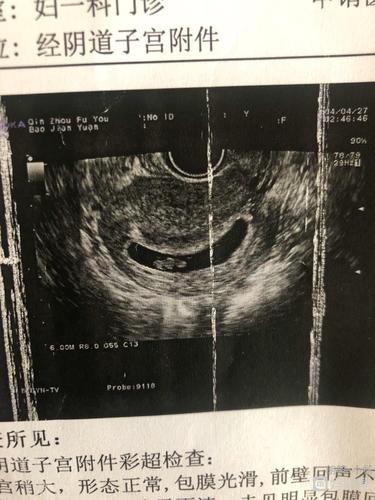 有没有跟我一样有子宫腺肌症自然怀孕的孕妈