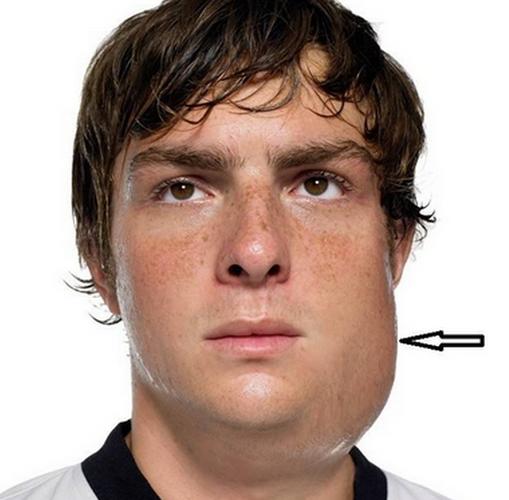 腮腺炎的早期症状 怎样确定得了该症,能自愈吗?