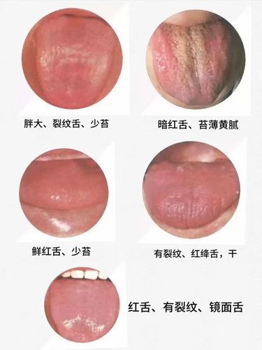阴虚体质舌表象