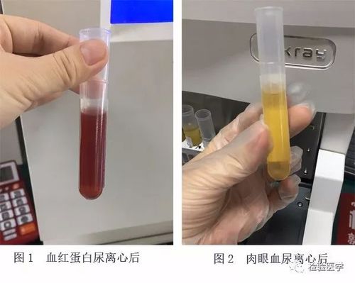 血尿及血红蛋白尿鉴别:   1.