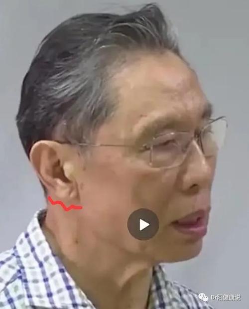 耳垂|冠心病|眼睑|皱褶