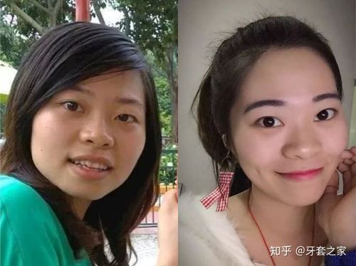 牙套会改变脸型吗