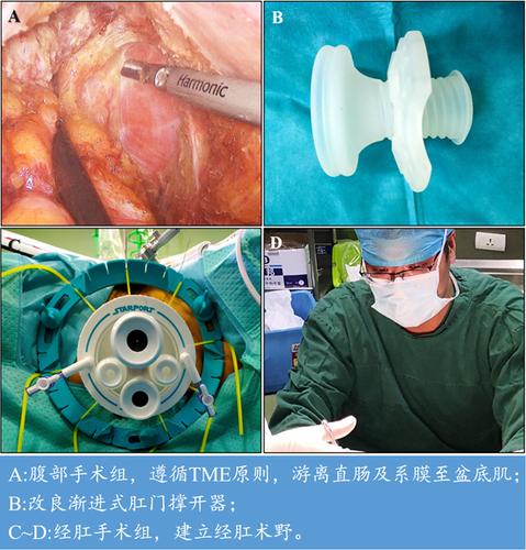 一附院胃肠外科成功开展皖北地区首例超低位直肠癌tatme保肛根治手术