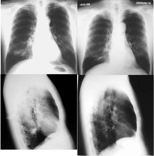 站内肺部球型阴影讨论