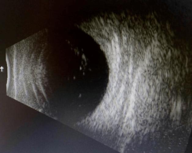 当玻璃体混浊时,玻璃体内可见絮状,条状回声,后运动明显,网膜在位.