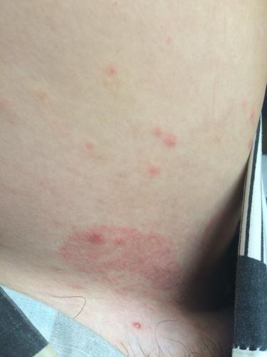 我人在国外大腿两内侧长了这些红的,我在网上查了,我怕是梅毒,这边