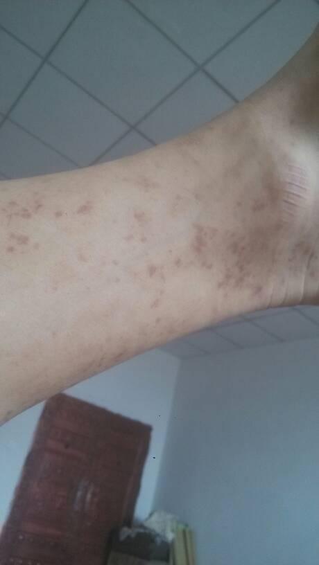 最近小腿上长了好多褐色的斑点!有好多,怎么回事啊