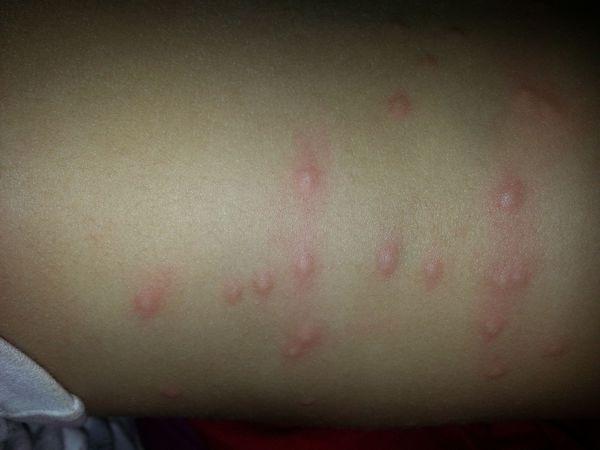 宝宝1岁半了身上起的红色疙瘩