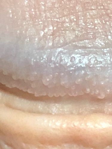 珍珠样丘疹:我很丑,但我很温柔