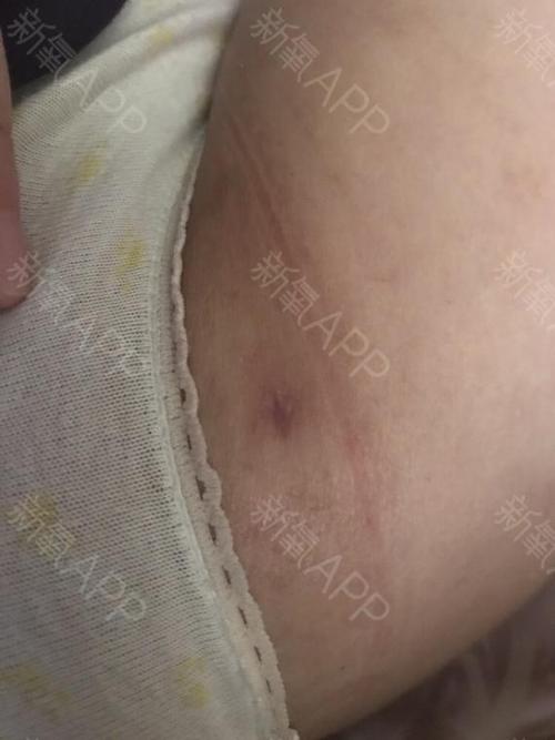 这段期间比较安慰的是两个方面:  一是原先大腿根部鼓起的一小坨