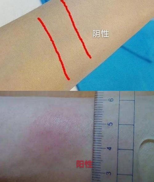 不过对于小孩,hiv感染患者等人群,阴性结果的解释需慎重.