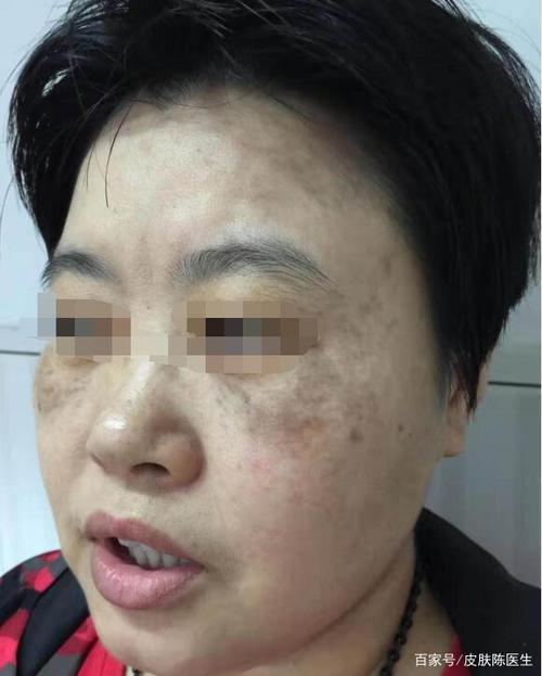 皮肤问题,女性面部斑点多,怎么解决?