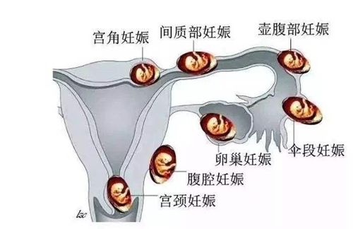 宫角妊娠是一种胚胎种植在接近子宫与输卵管开口交界处的宫角部的子宫