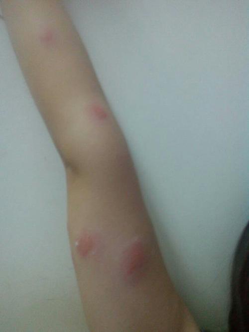 2014-07-03 孙莉 医师 服用盐酸克林霉素棕酸脂片三次发现孩子眼角两