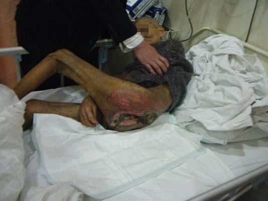 瘫痪病人双臀巨大褥疮vac配合波浪床治疗