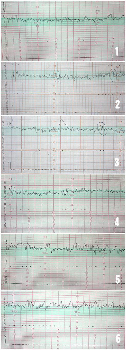请看哈,左边是我做过的全部六次胎心监测图.