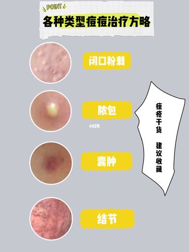 各种类型痘痘 治疗方法推荐_痘痘_维a酸_痘印痘坑_抗生素_搭配_美妆