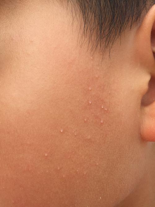 小孩子脸上起了很多白色的小痘痘,像粉刺一样.请问是怎么回事呢?