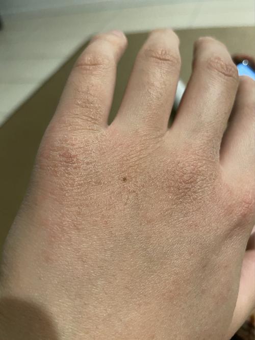 手背上一半长红点,一半干裂,太难了_湿疹_brisbane casino towers自由