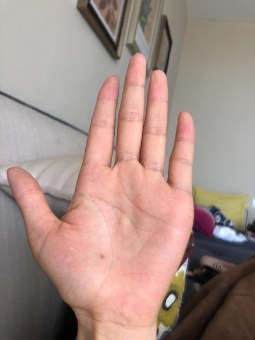 女,31岁,左手掌生命线附近有痣好吗?生命线的左边