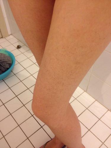 毛囊角质化引起的小红点用芯丝翠产品能奏效