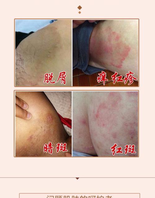 男女大腿内侧体股手足皮肤痒藓廯外用软膏肛门阴囊外阴止痒膏成人