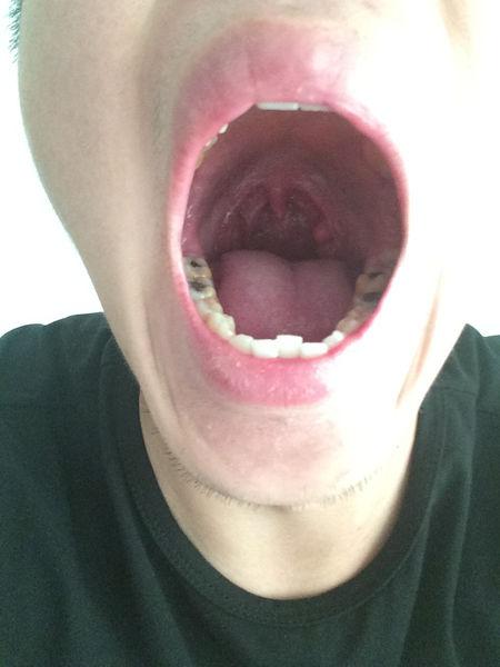 问:喉咙里张了个小疙瘩,在扁桃体位置.