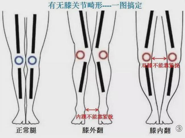 什么是膝关节外翻畸 ??