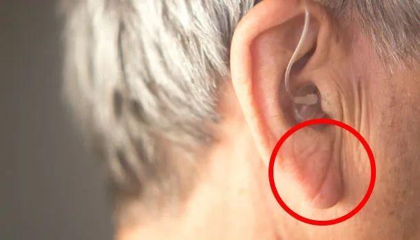 谣言榜耳垂有皱褶就会得冠心病