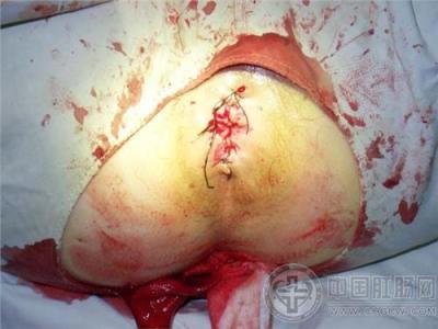 痔疮手术费要多少钱 痔疮手术好不好呢