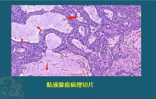 上图是一位黏液腺癌病人的病理切片,深蓝色斑点是癌细胞,一片一片的