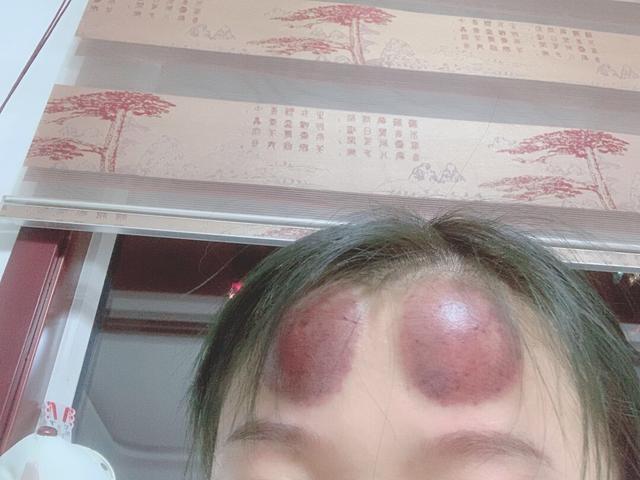 那个告诉我媳妇说额头上拔罐能治头疼的人,你的良心不