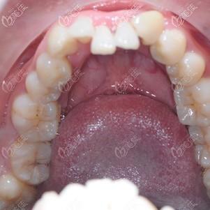 两颗下门牙往里凹在东莞牙易美带上时代天使牙套后同事们都没人看出来