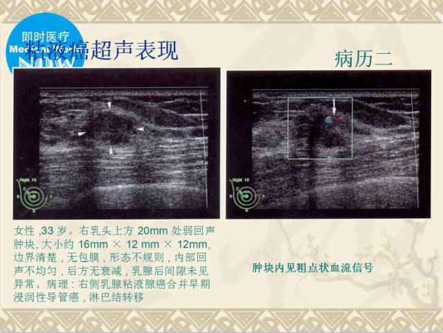 汇总史上最详细乳腺恶性肿瘤的超声诊断有图有真相