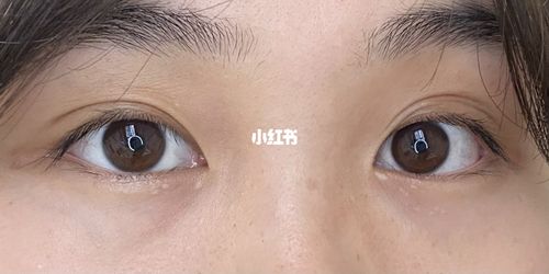 眼睛周围的长的这是脂肪粒还是血管瘤_血管瘤_脂肪粒