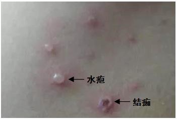 一般2-3周后皮疹全部结痂,脱落.