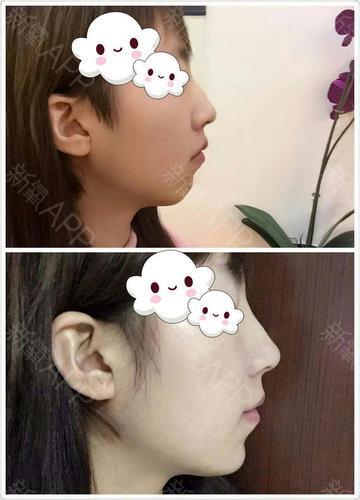 ccs无人像你肉毒素颏肌放松第59天美丽日记
