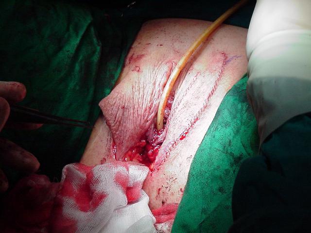 【转载】变性手术(男变女,血腥慎入)