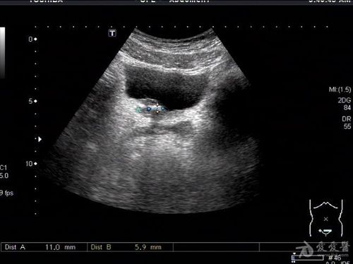 膀胱壁内段结石 - 超声医学讨论版 - 爱爱医医学论坛