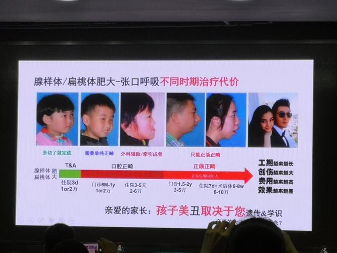 腺样体肥大的诊治