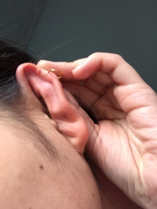 耳洞旁边长了一小个肉瘤怎么办
