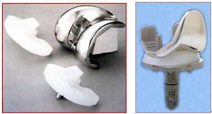 专家谈关节疾病与人工置换