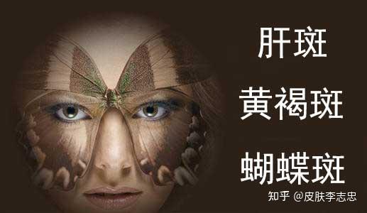 中医解析面部黄褐斑的病因