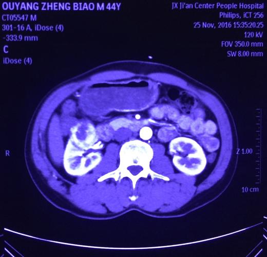 中央型肾癌的不阻断肾蒂机器人辅助经腹膜后腔"超薄层