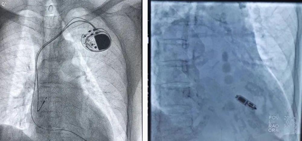 仅重2克!桂医二附院成功完成首例无导线起搏器植入手术!