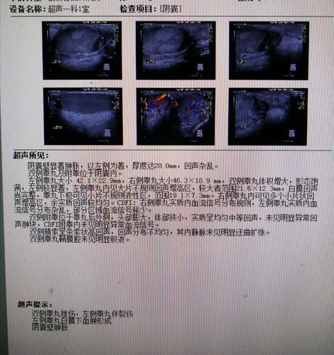 左侧睾丸破裂双侧睾丸挫伤1例