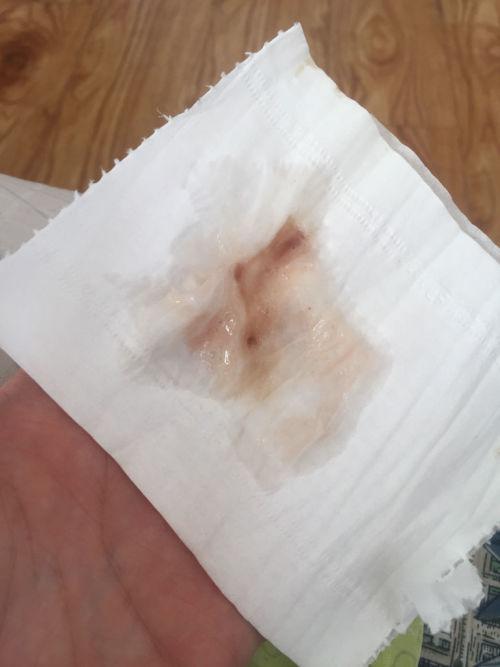 26岁吐痰咽炎患者今年吐痰早上第一口中带深色小肉块深褐色如图的痰