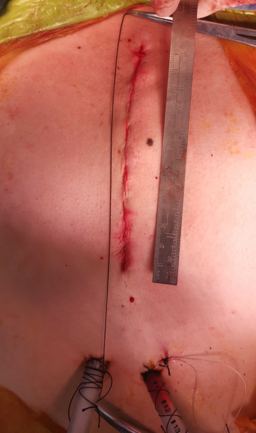 微创心脏外科手术简介