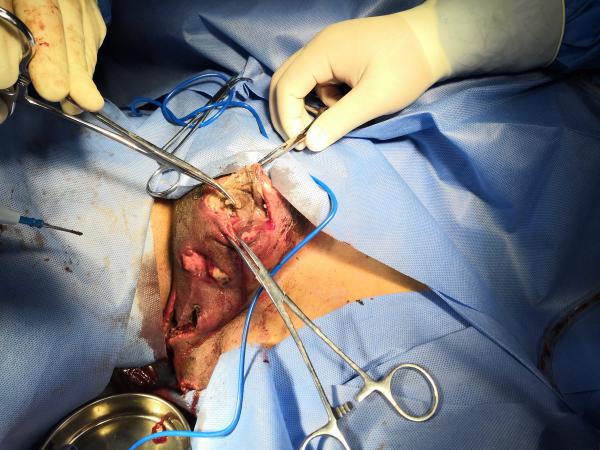 慢创中心完成首例结肠造瘘术